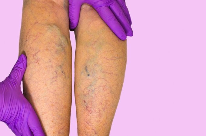 What Is Varicose Veins Disease? Which Treatment Option Would Be Best For You ?